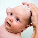 Cradle cap in babies